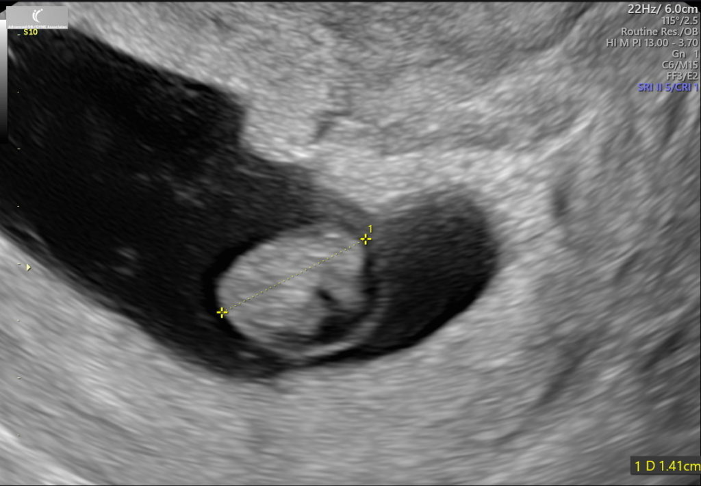 7 Weeks Pregnant Ultrasound