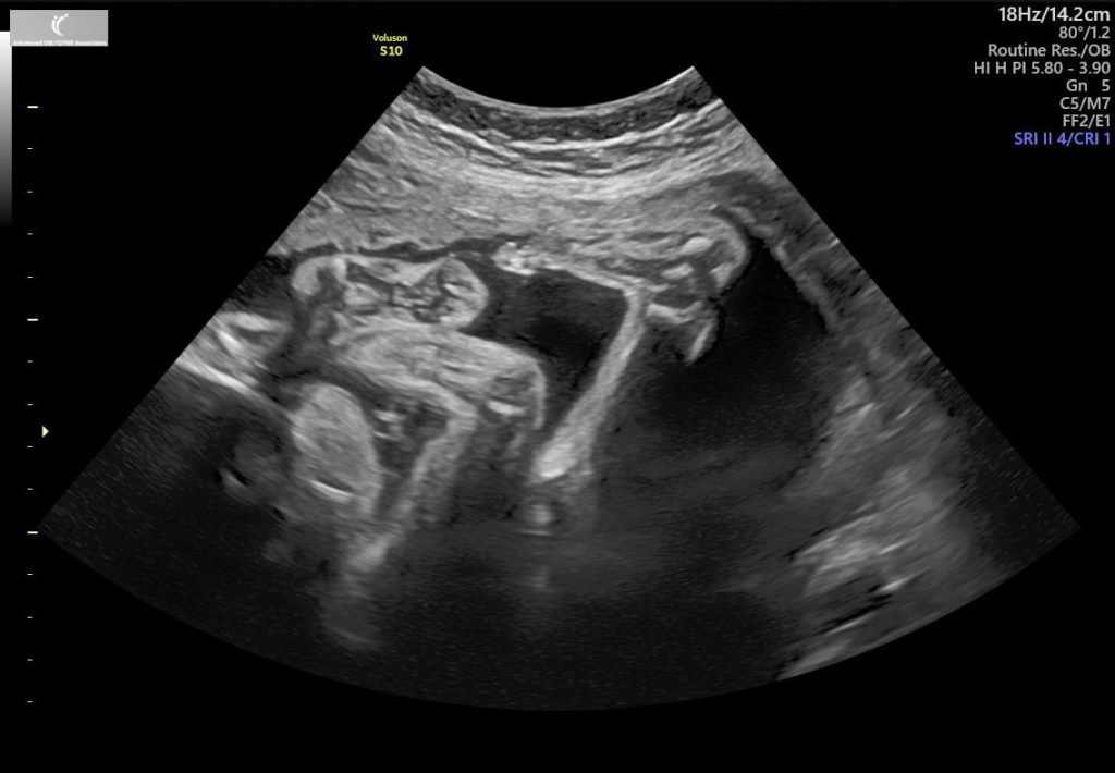 28 weeks pregnant ultrasound
