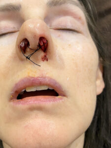 A woman's face after septoplasty with her nose filled with packing gauze and black string tied around the packing. Her mouth is open and she is asleep.